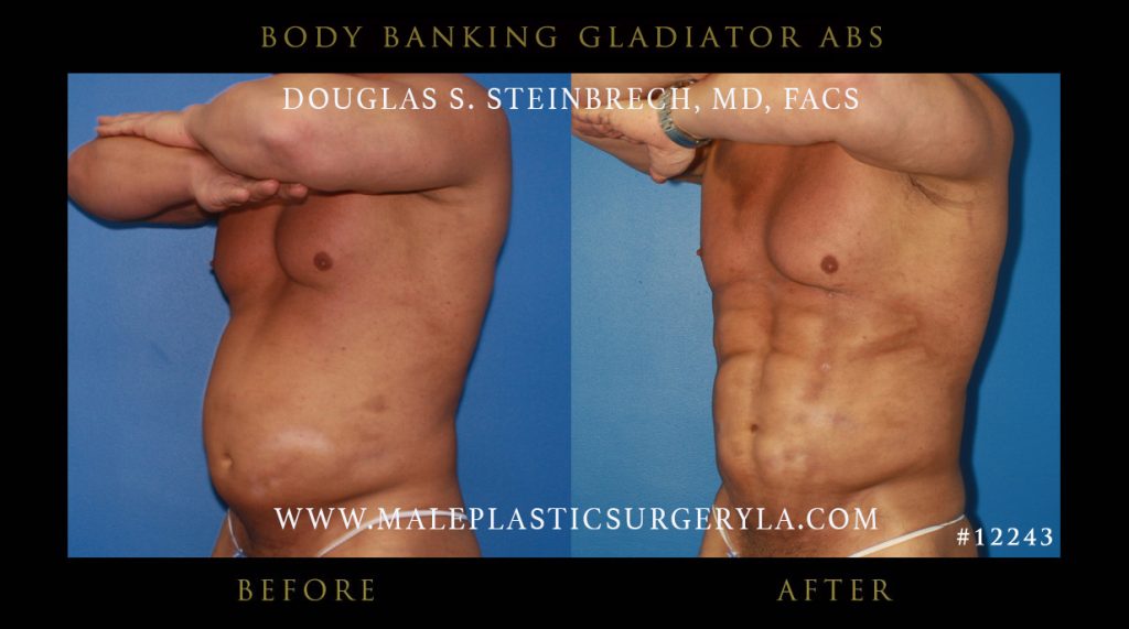 Gladiator Abs - Before & After Photos