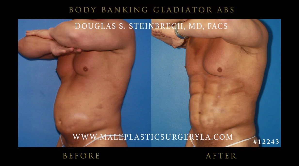 Gladiator Abs - Before & After Photos