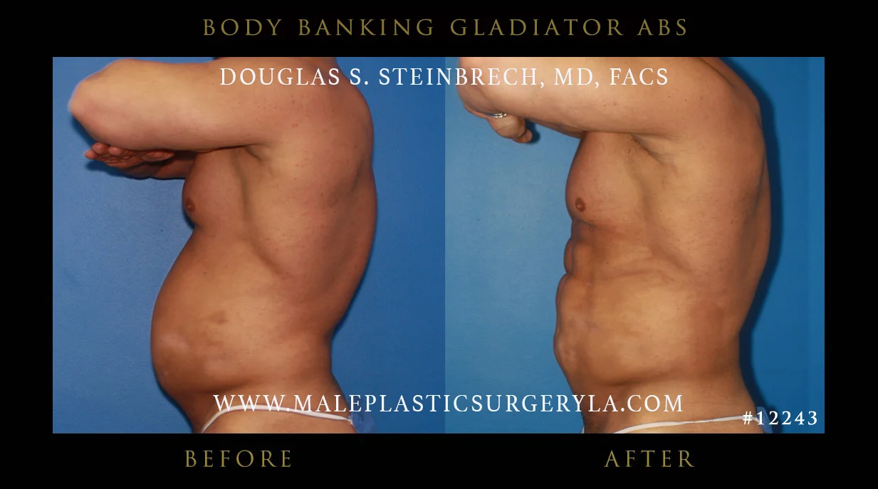 Gladiator Abs - Before & After Photos