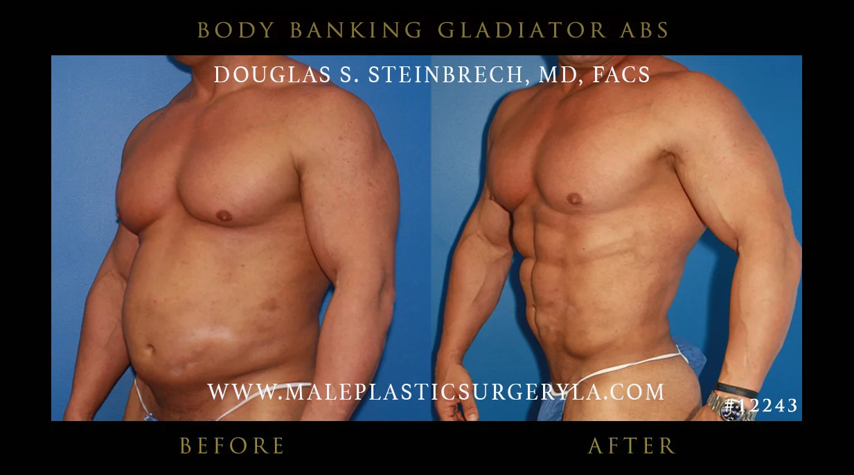 Gladiator Abs - Before & After Photos