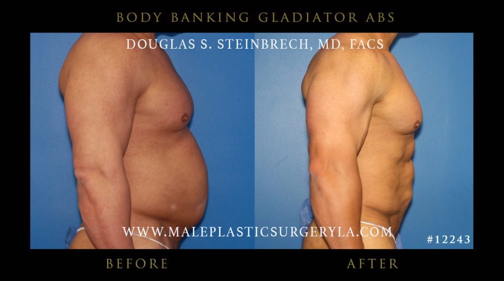 Gladiator Abs - Before & After Photos