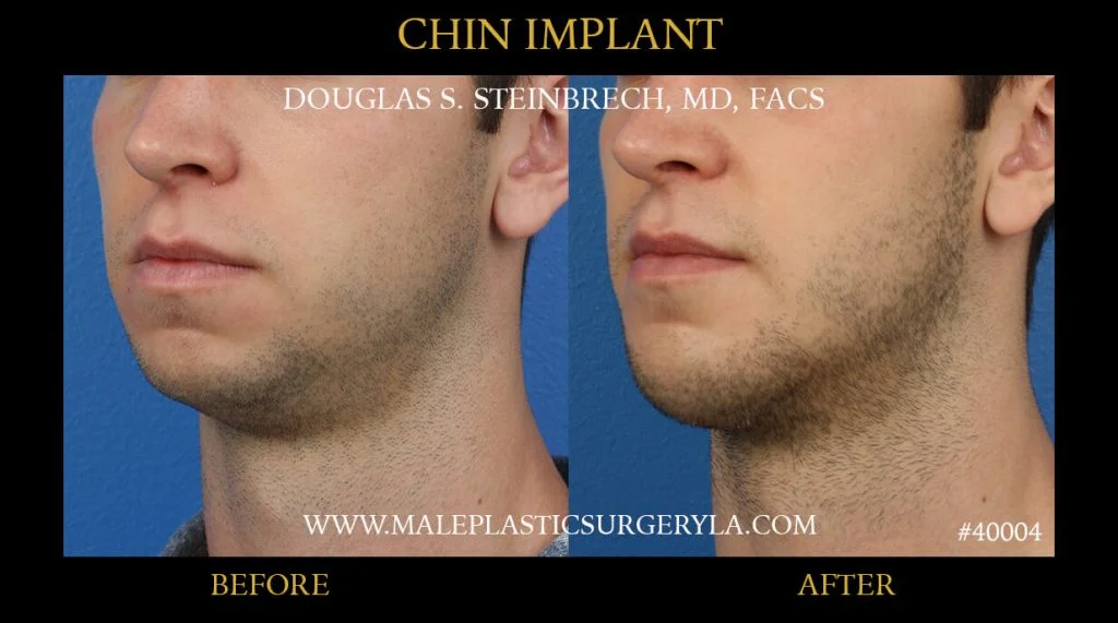 Chin Implants Gallery - Male Plastic Surgery Los Angeles
