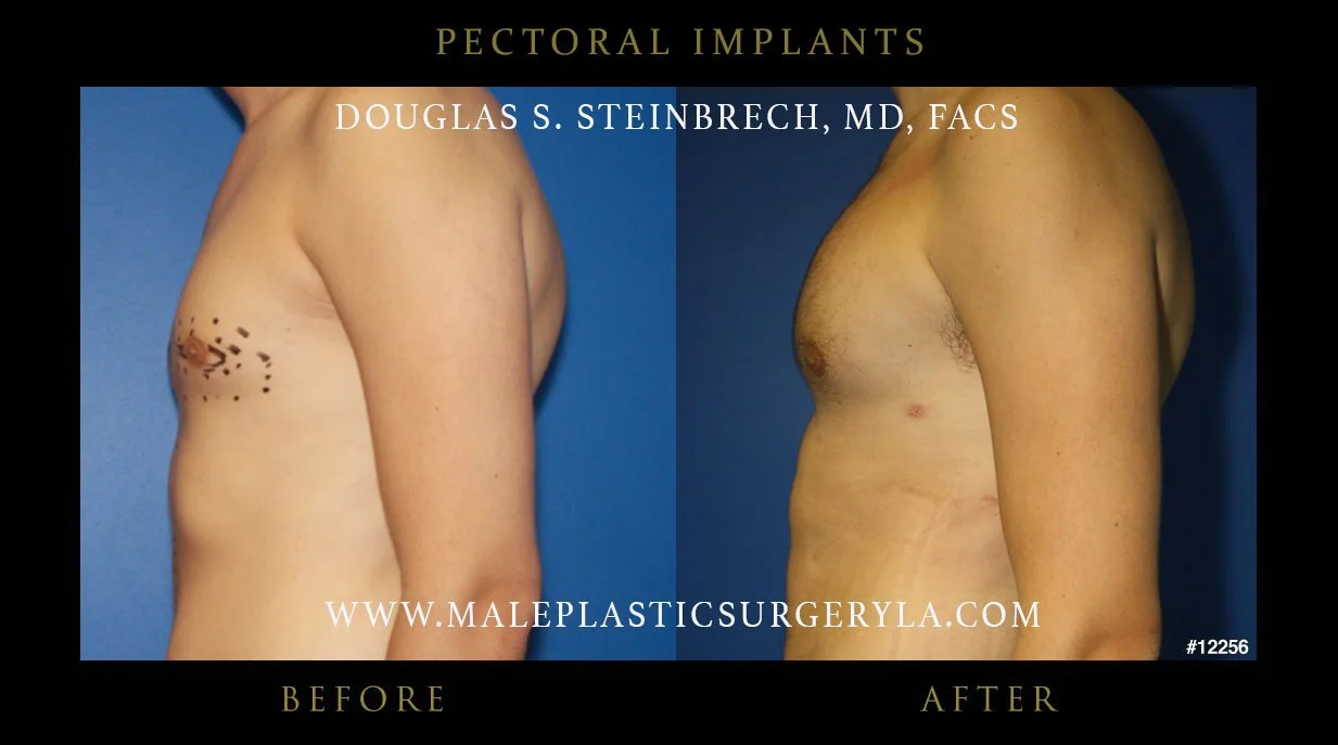 Pectoral Chest Implant - Before & After Photos