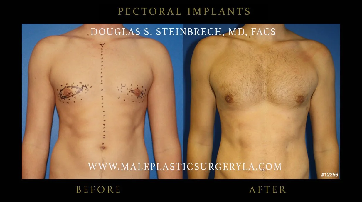 Pectoral Chest Implant - Before & After Photos