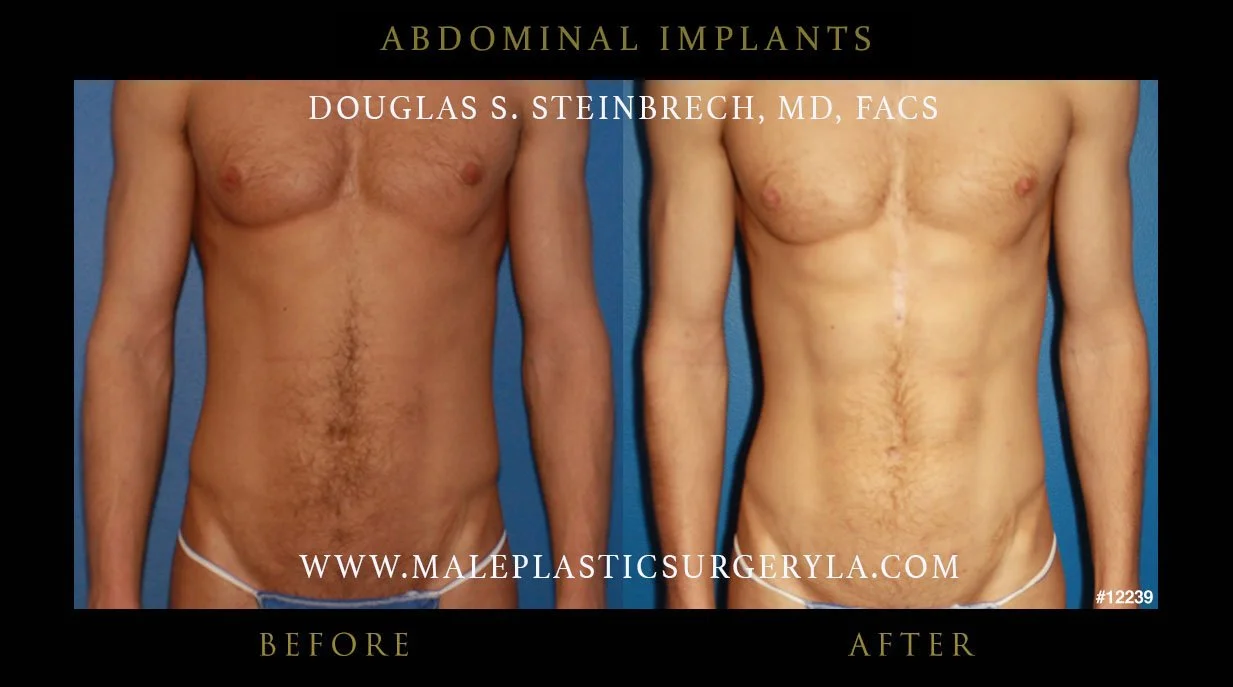 Abdominal Implants - Before & After Photos