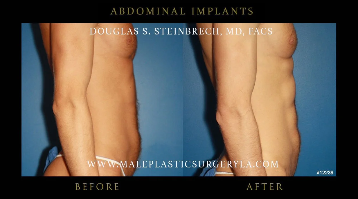 Abdominal Implants - Before & After Photos