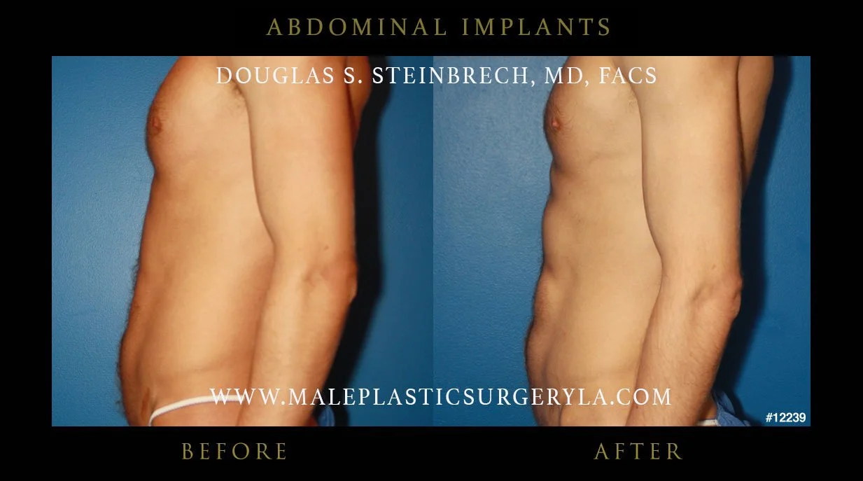 Abdominal Implants - Before & After Photos