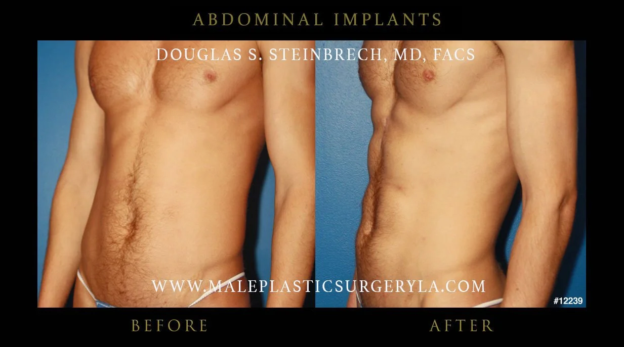 Abdominal Implants - Before & After Photos