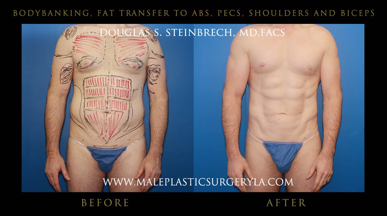 Liposuction - Before & After Photos