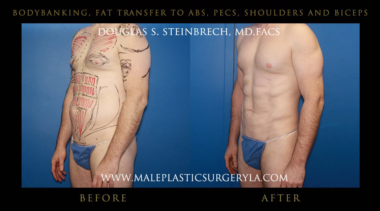 Liposuction - Before & After Photos