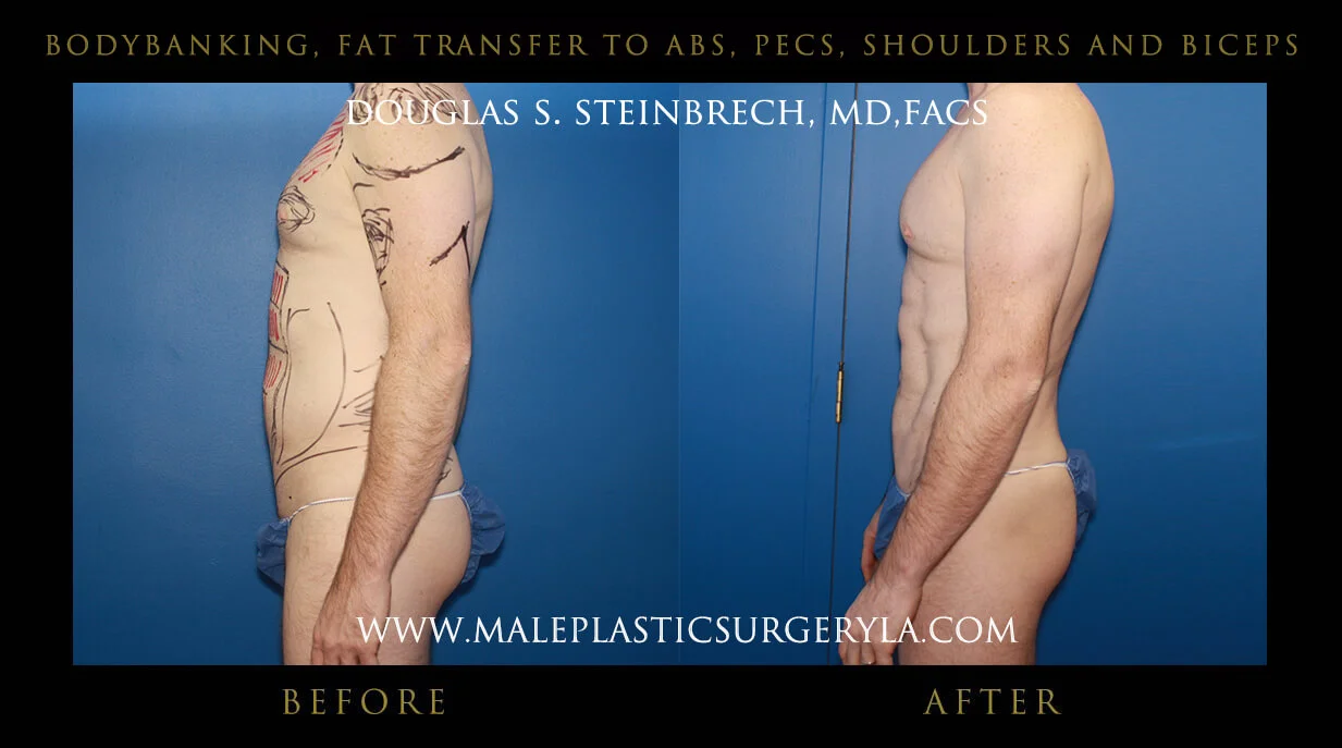 Liposuction - Before & After Photos