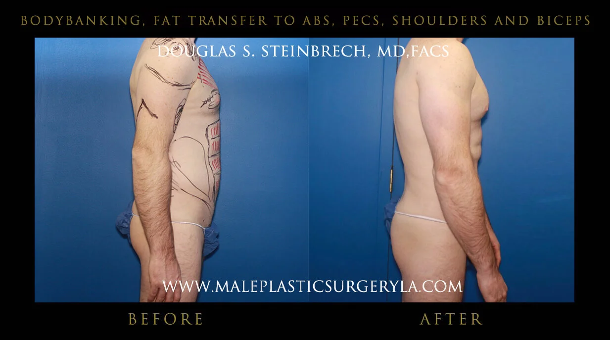 Liposuction - Before & After Photos