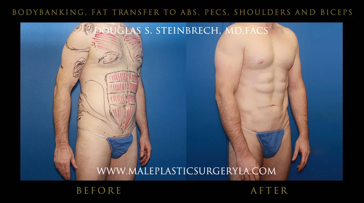 Liposuction - Before & After Photos