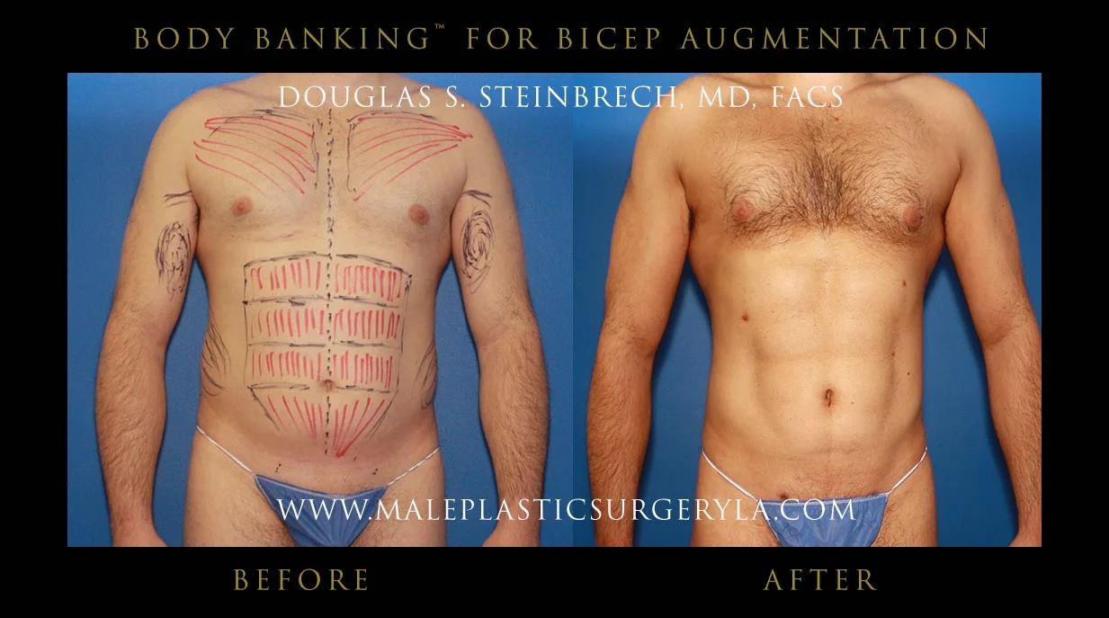 Liposuction - Before & After Photos