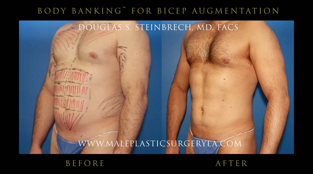 Liposuction - Before & After Photos