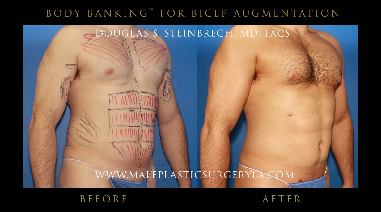 Liposuction - Before & After Photos