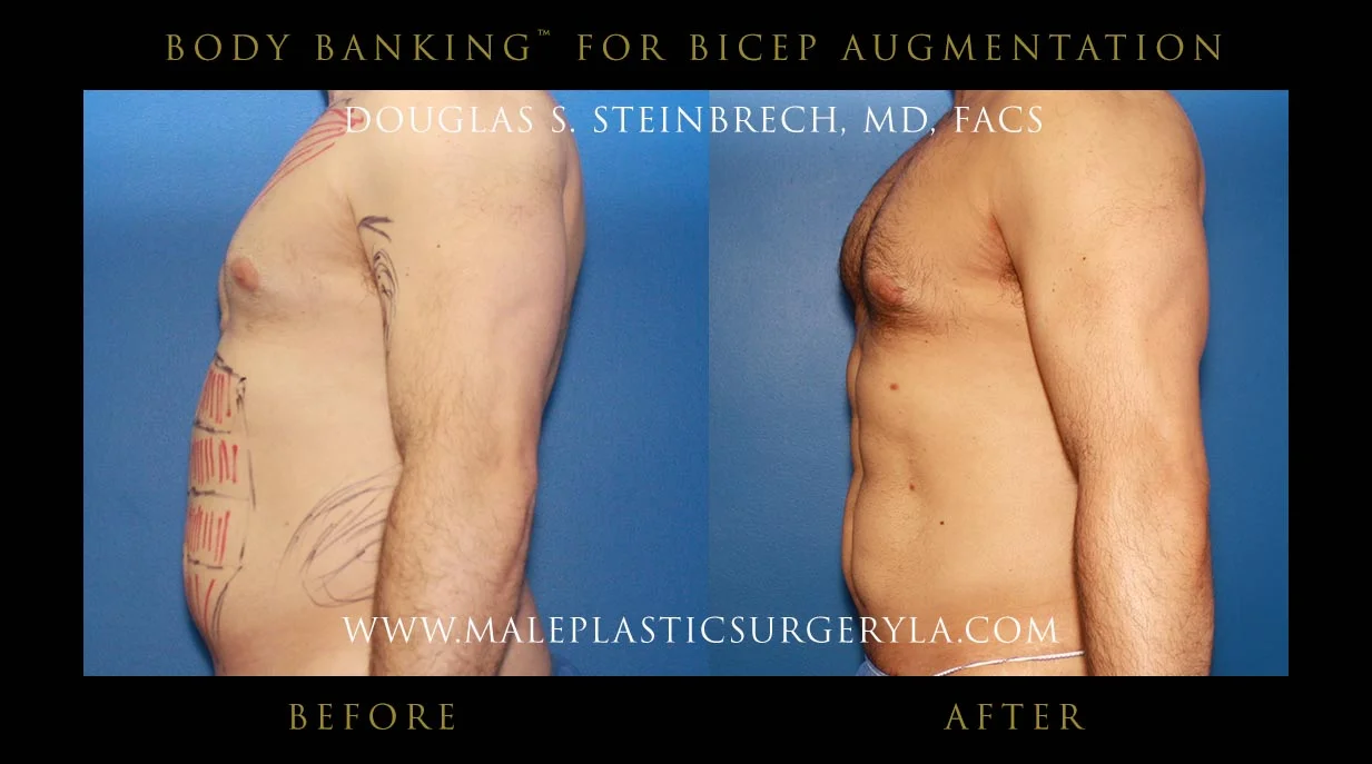 Liposuction - Before & After Photos