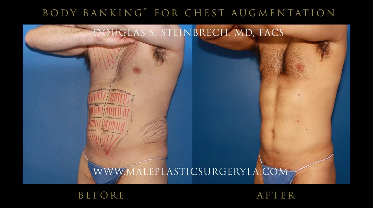 Liposuction - Before & After Photos