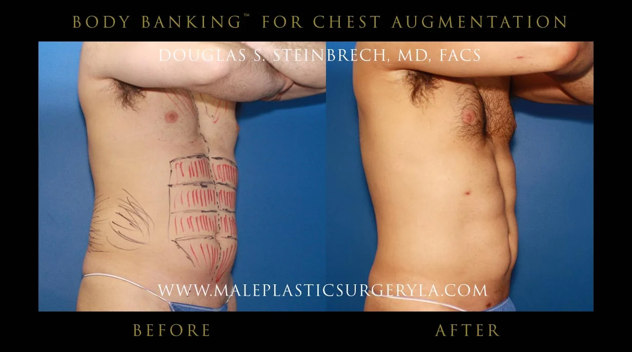 Liposuction - Before & After Photos