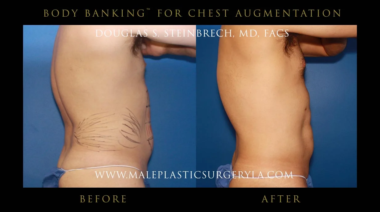 Liposuction - Before & After Photos