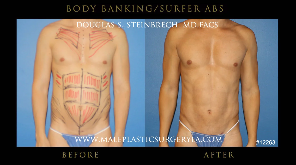 Liposuction - Before & After Photos