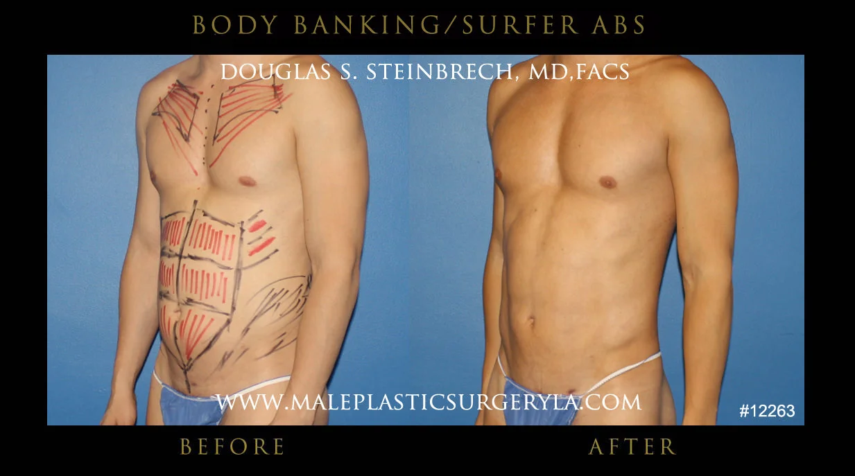 Liposuction - Before & After Photos