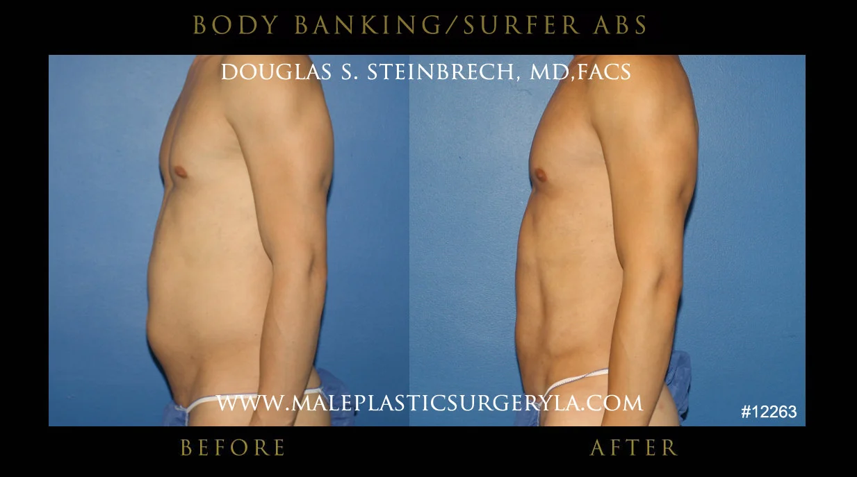 Liposuction - Before & After Photos