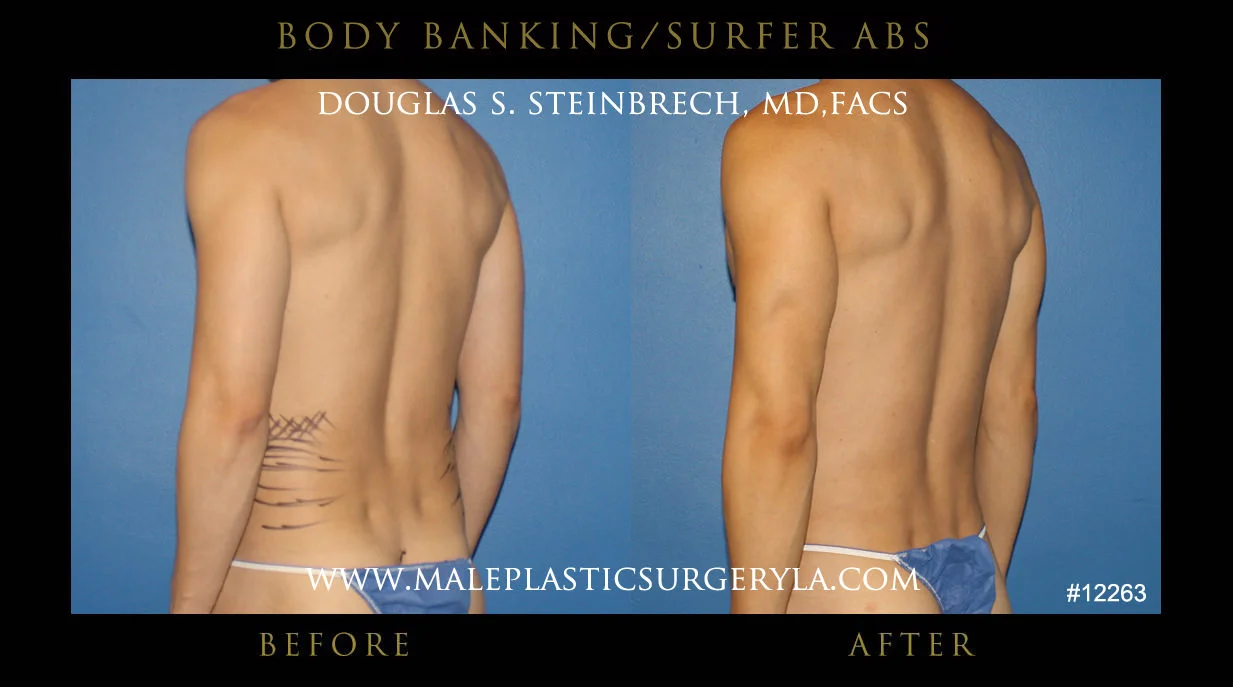 Liposuction - Before & After Photos