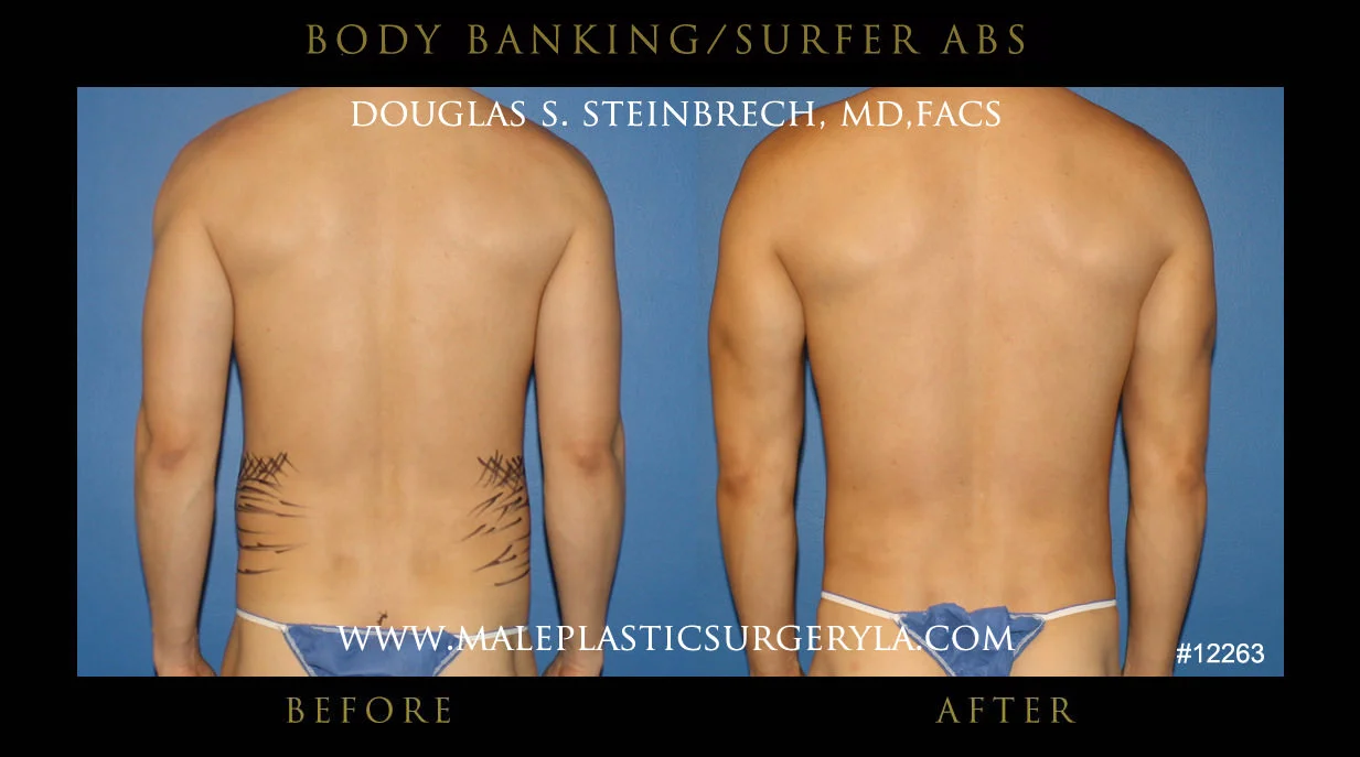 Liposuction - Before & After Photos