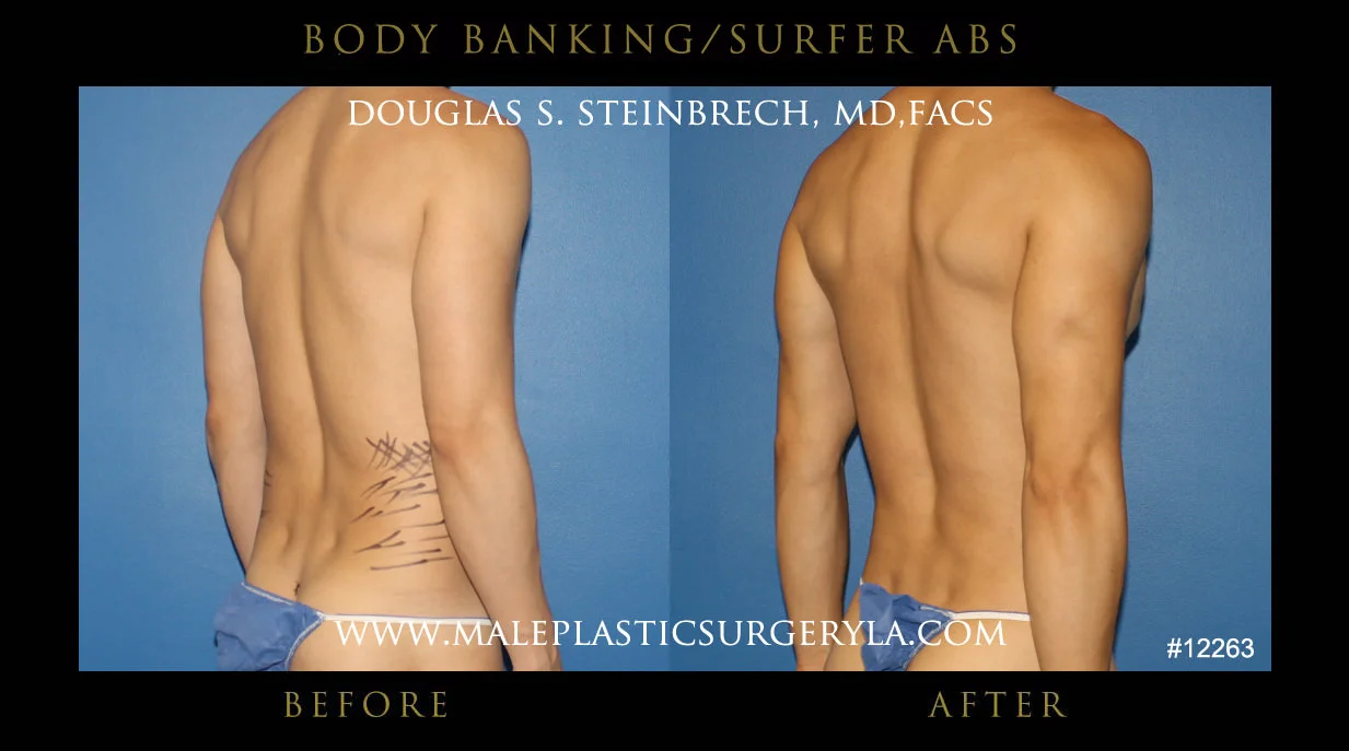 Liposuction - Before & After Photos