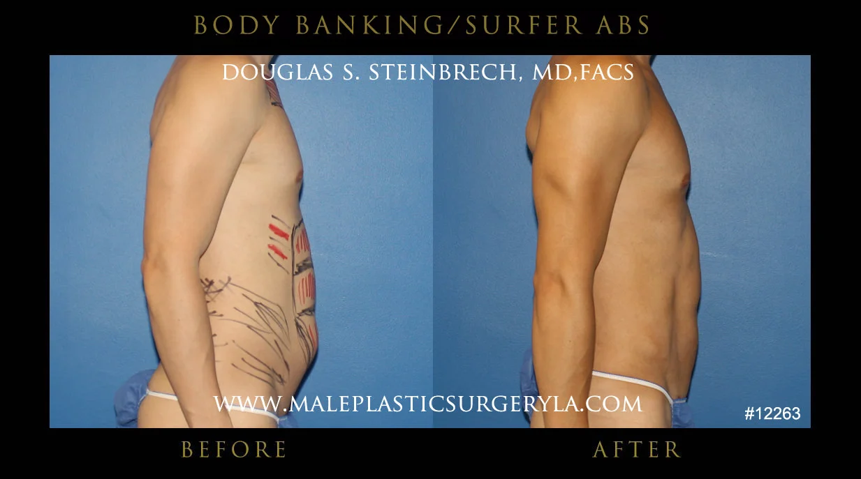 Liposuction - Before & After Photos