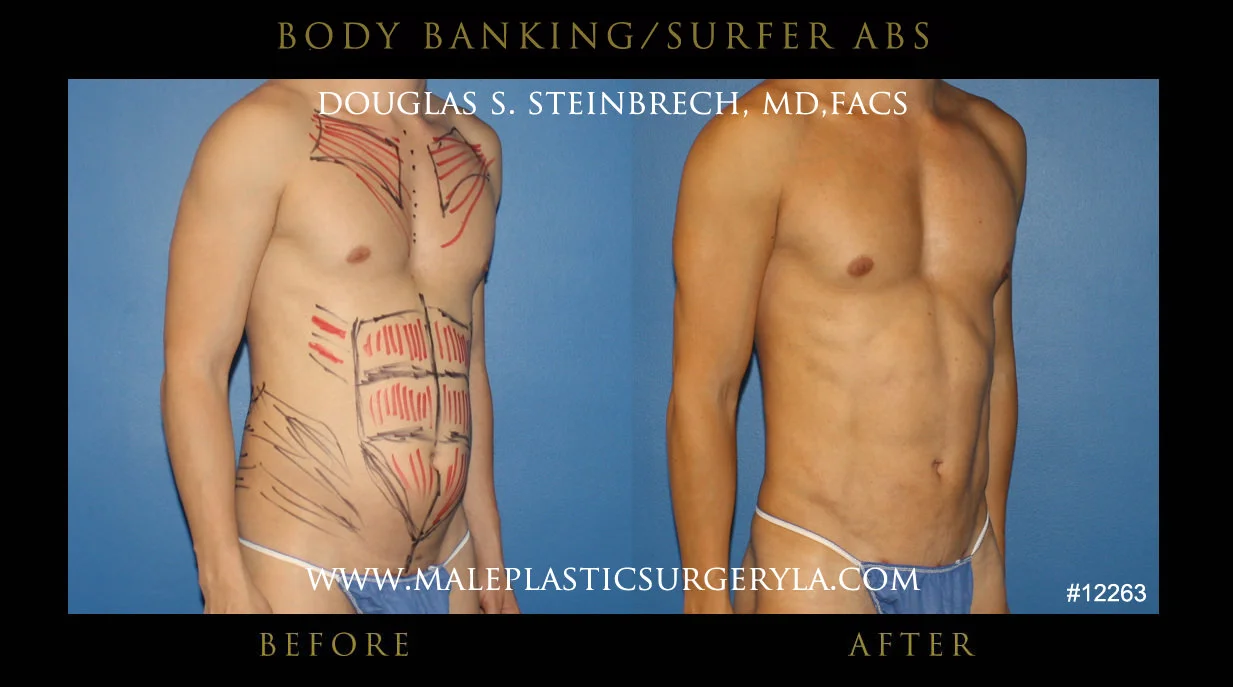 Liposuction - Before & After Photos