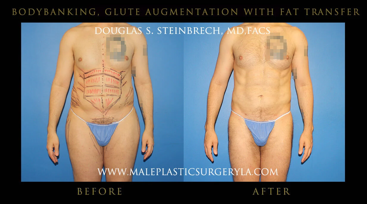 Liposuction - Before & After Photos