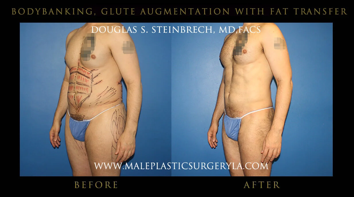 Liposuction - Before & After Photos