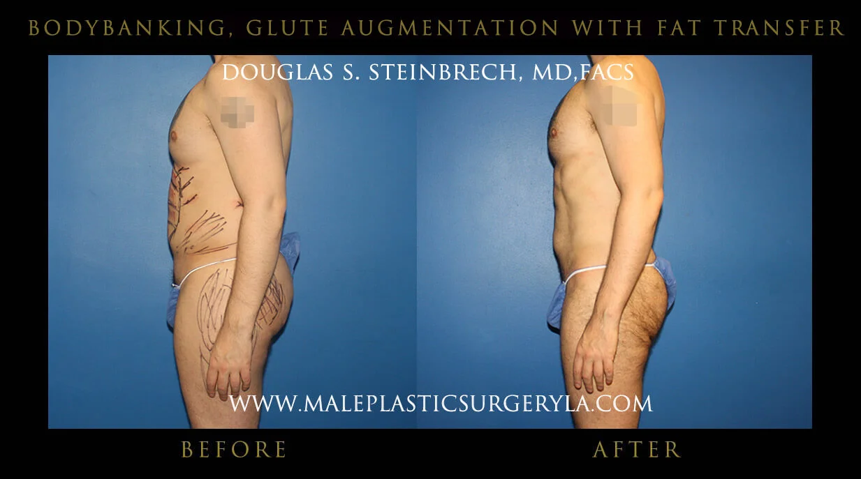 Liposuction - Before & After Photos