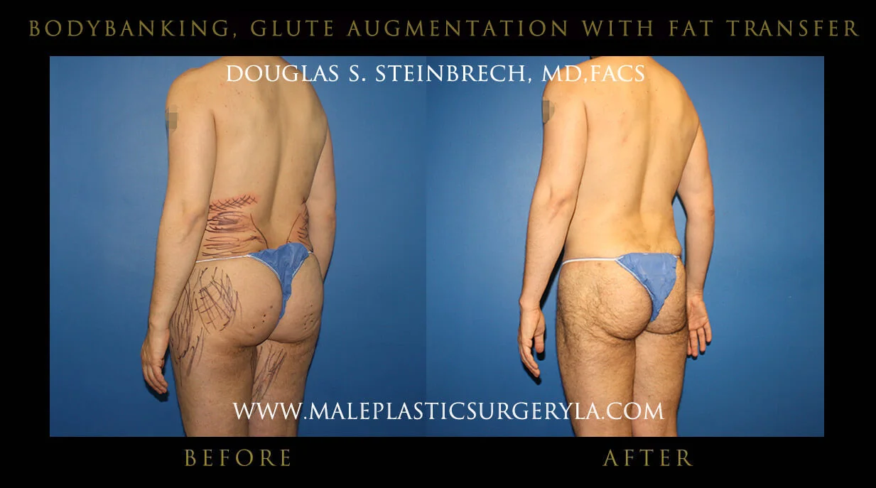 Liposuction - Before & After Photos