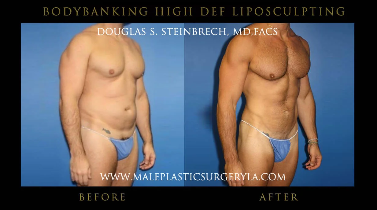 Liposuction - Before & After Photos