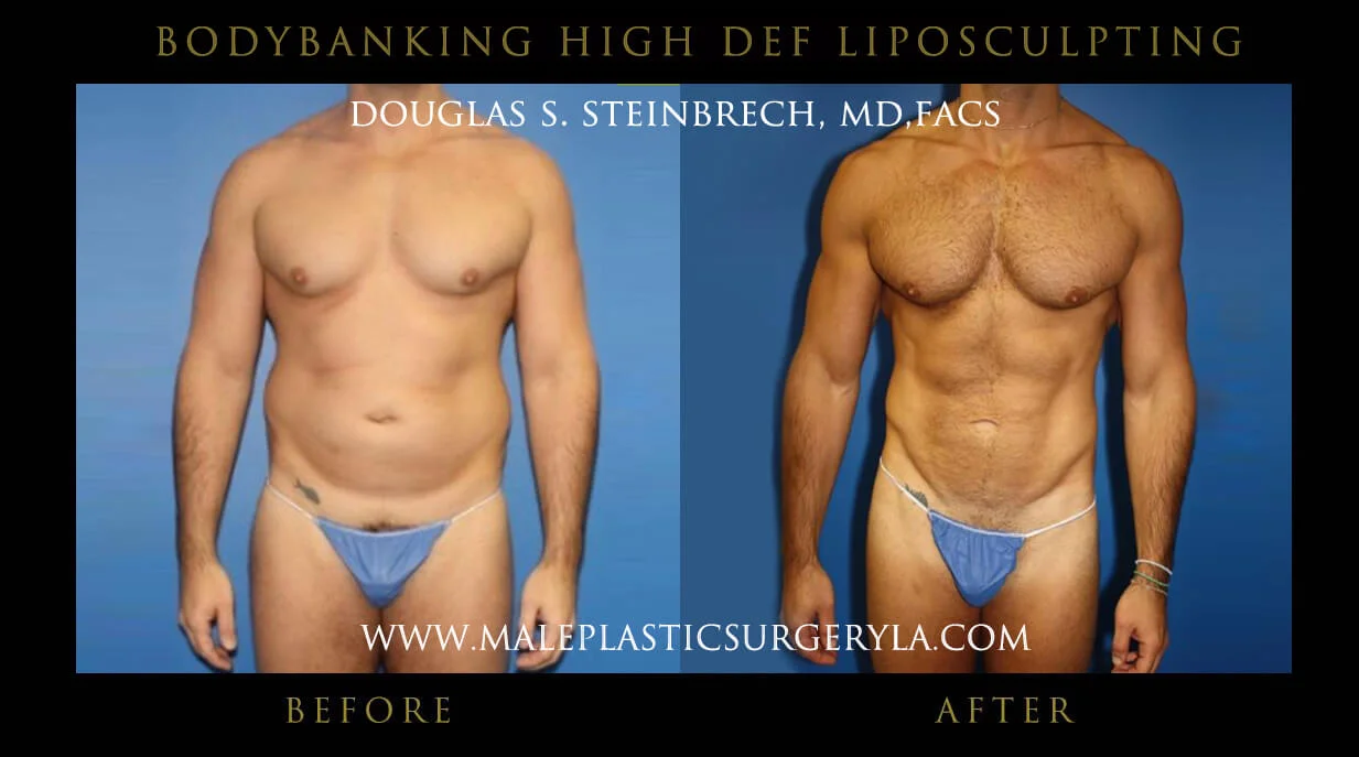 Liposuction - Before & After Photos