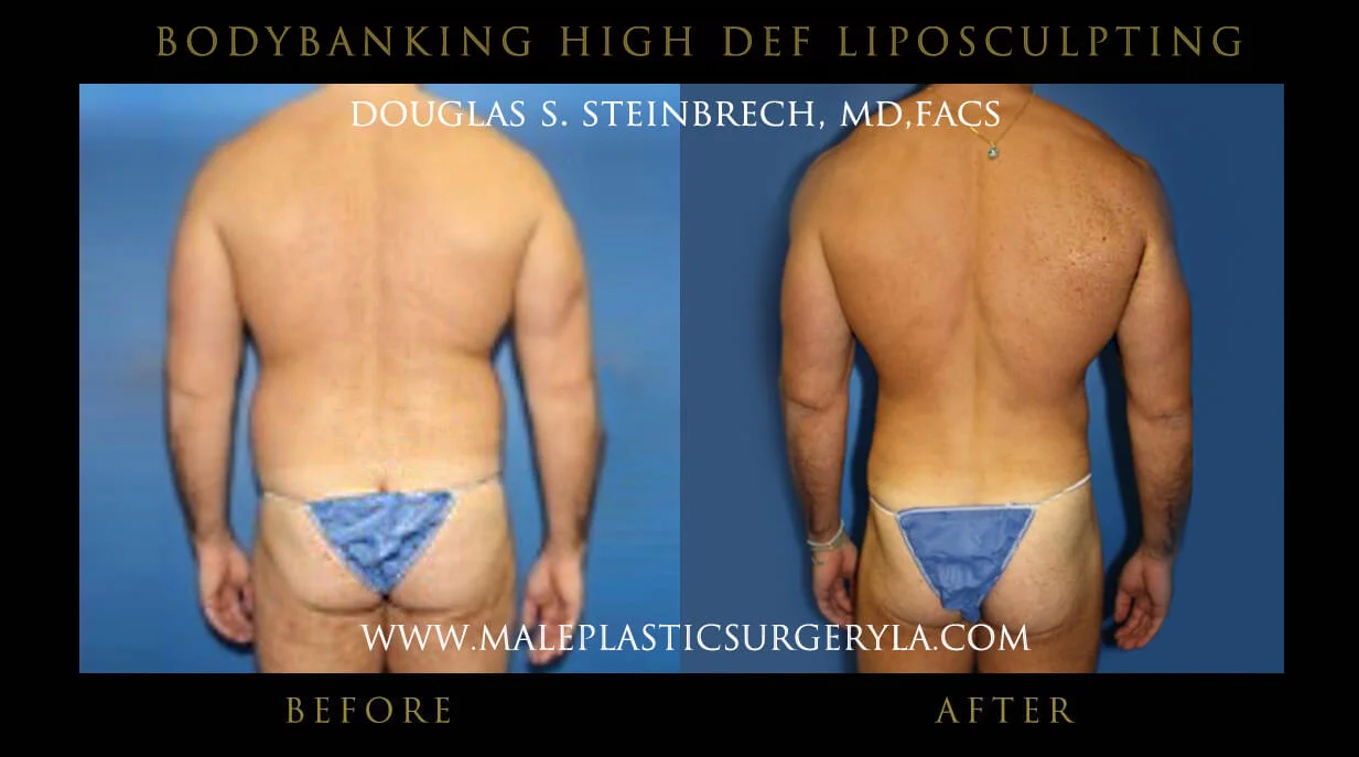 Liposuction - Before & After Photos