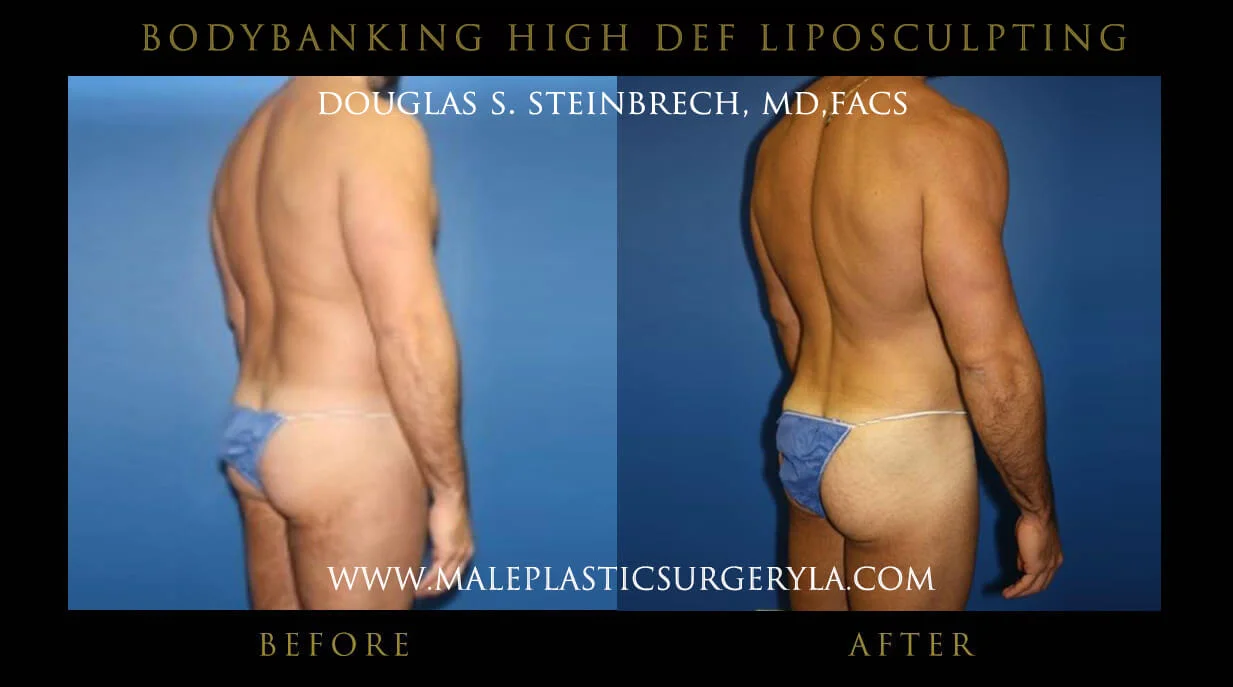 Liposuction - Before & After Photos