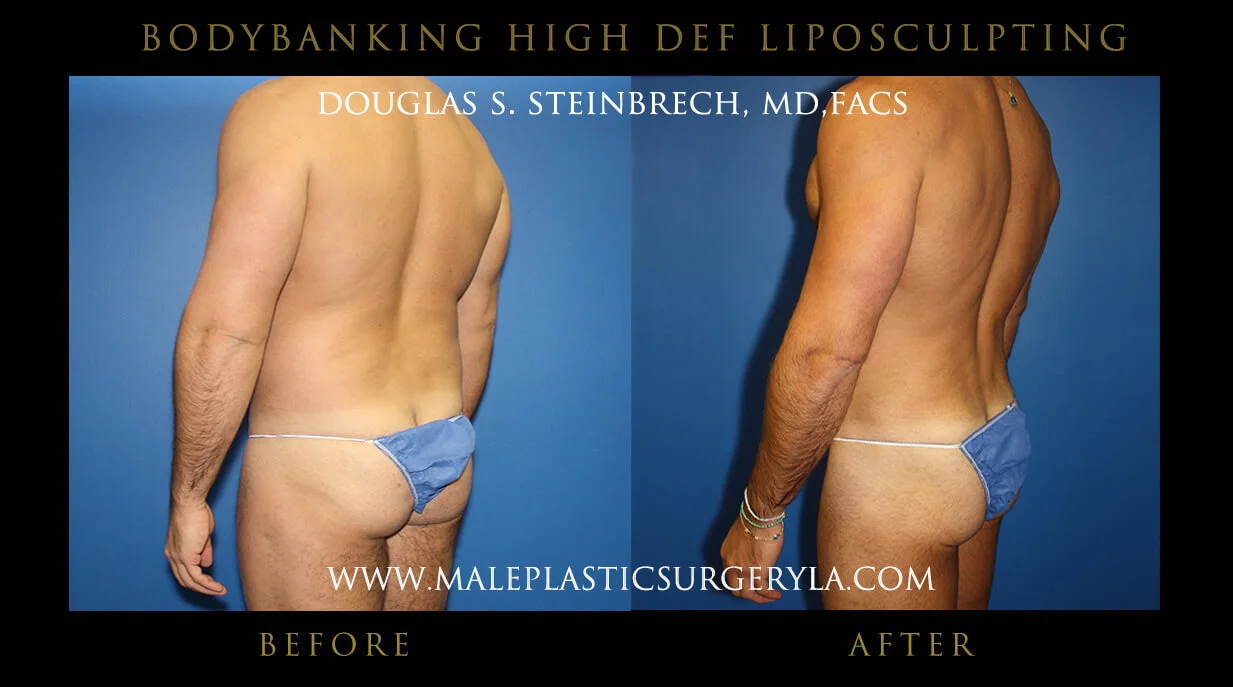 Liposuction - Before & After Photos