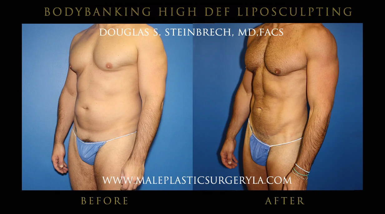 Liposuction - Before & After Photos