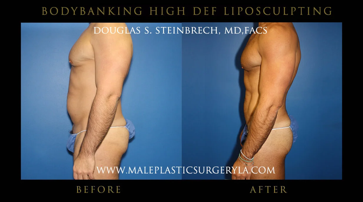 Liposuction - Before & After Photos