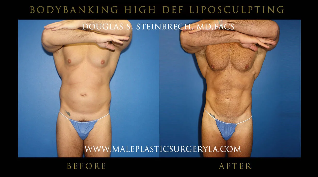 Liposuction - Before & After Photos