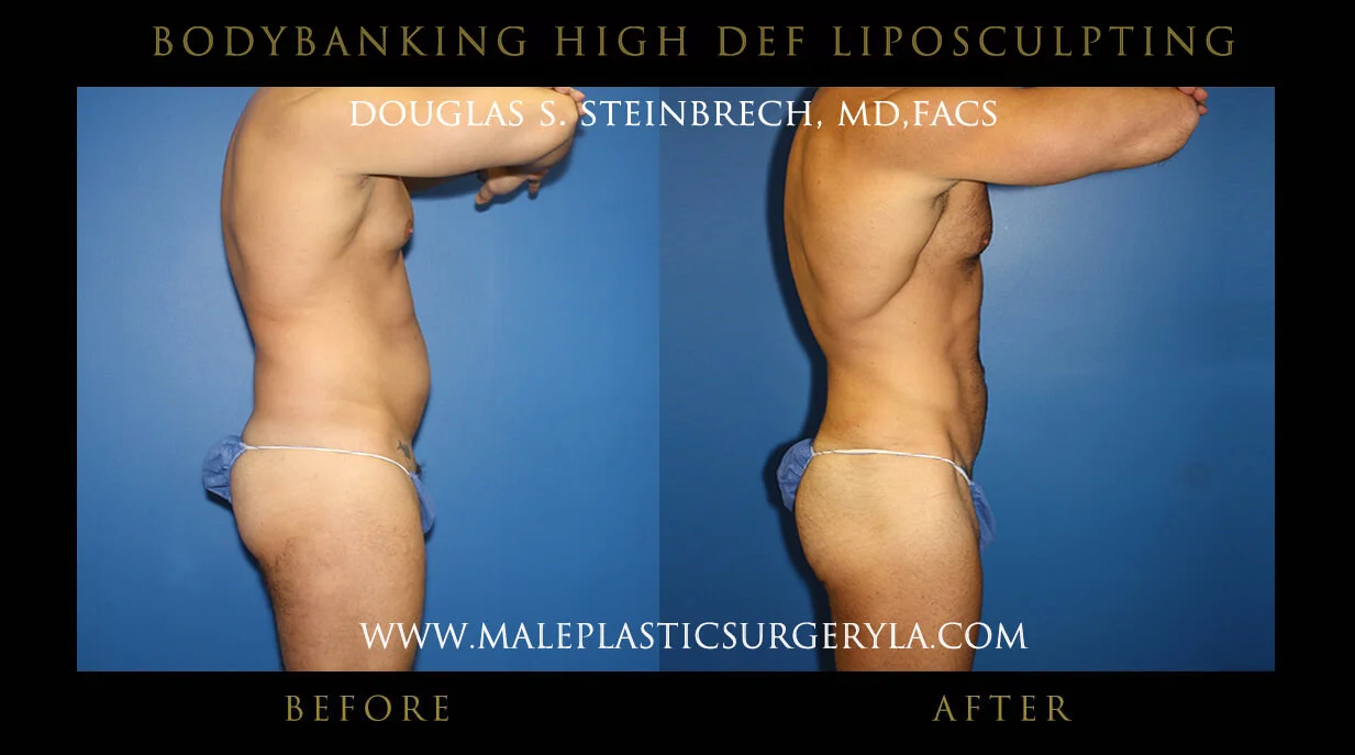 Liposuction - Before & After Photos