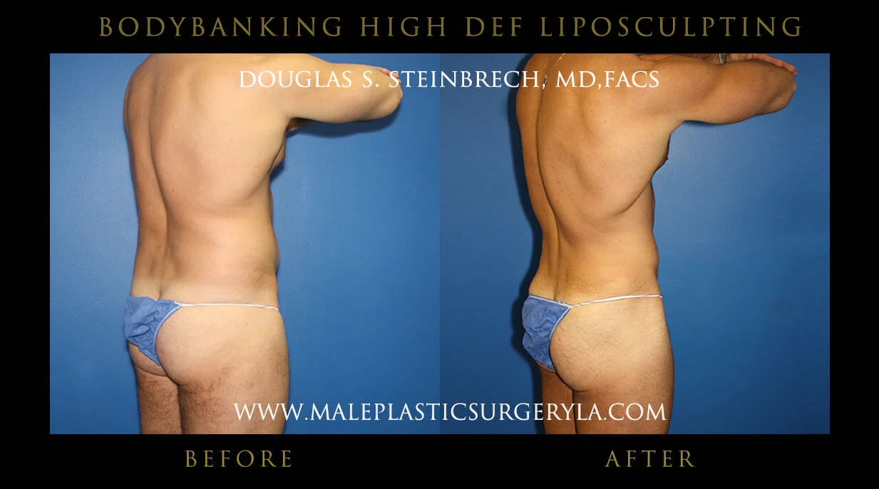 Liposuction - Before & After Photos