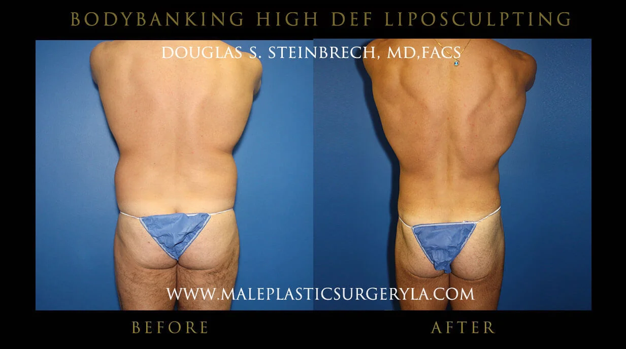 Liposuction - Before & After Photos