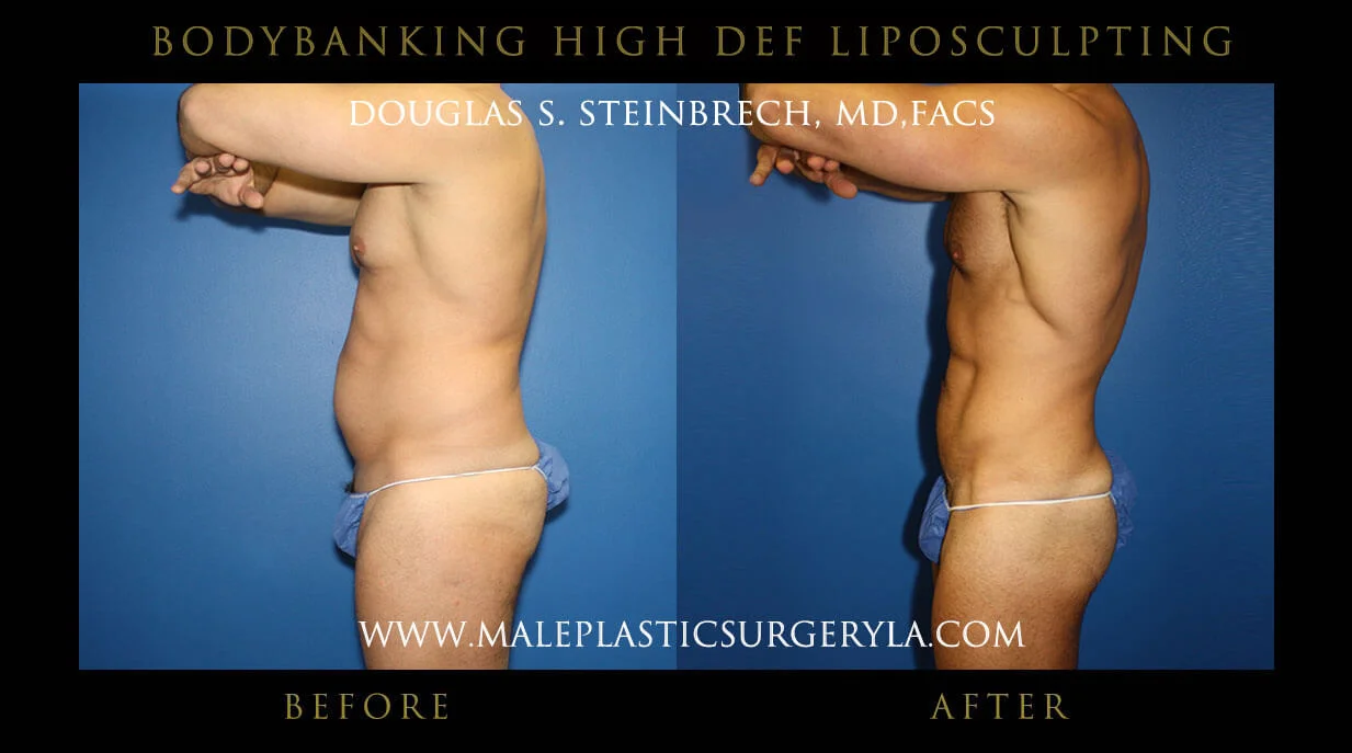 Liposuction - Before & After Photos