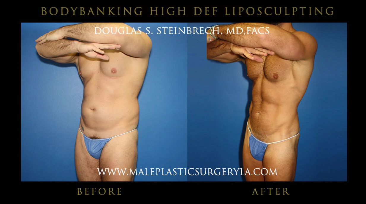 Liposuction - Before & After Photos