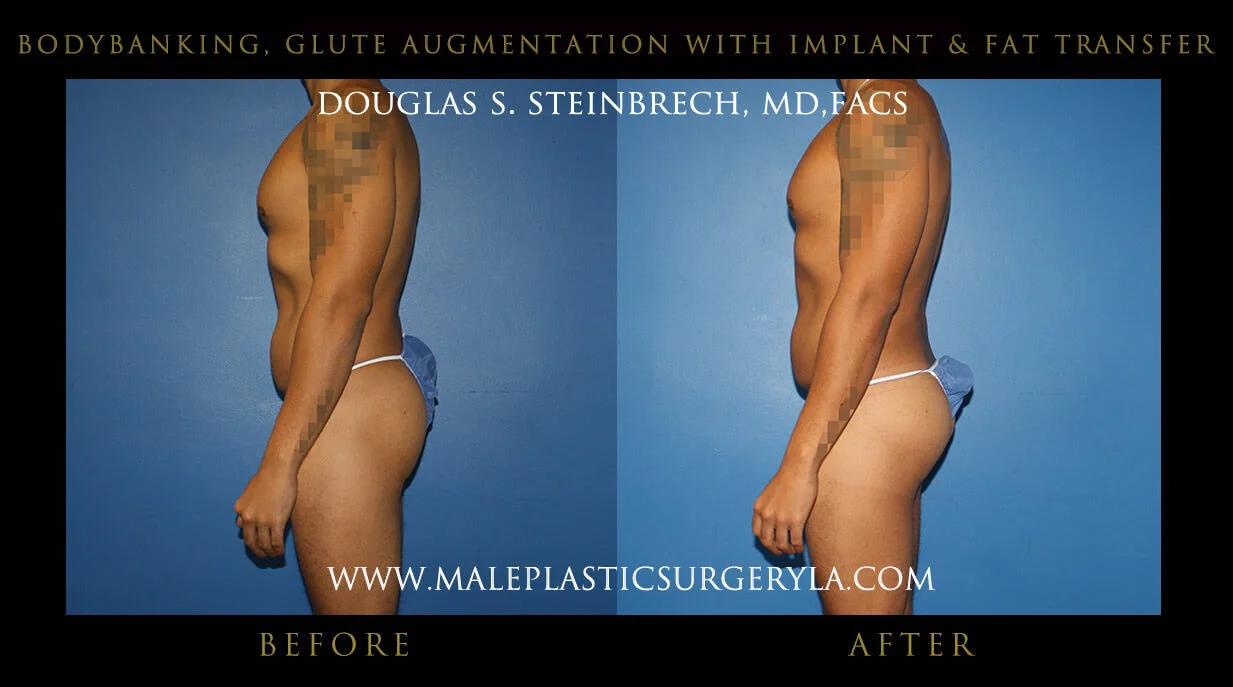 Liposuction - Before & After Photos